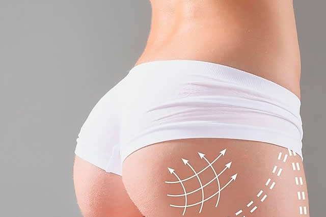 RESULTADOS LIPOVASER EN QUITO